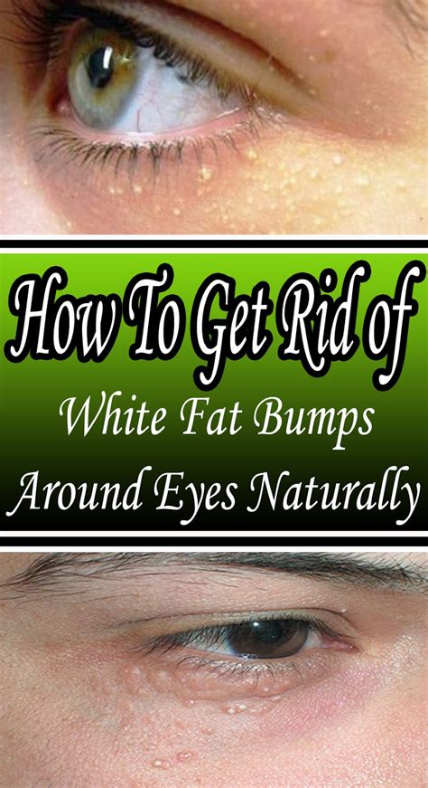 How To Get Rid Of White Fat Bumps Around Eyes Naturally Exstremboard