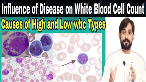Influence Of Disease On White Blood Cell Count Causes Of Low And