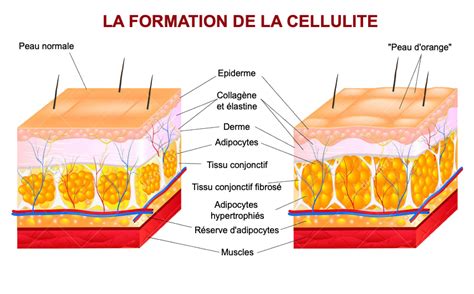 Comment Traiter La Cellulite Libourne Bordeaux Dr Klein