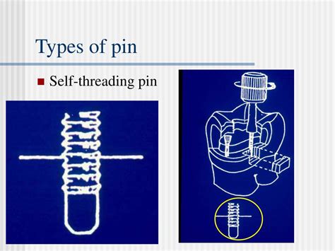 Ppt Use Of Dental Pin Powerpoint Presentation Free Download Id901756