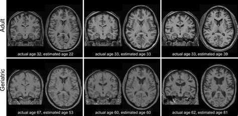 Comparison Of Structural MRI Of Participant Brains In Midlife And Older Download Scientific