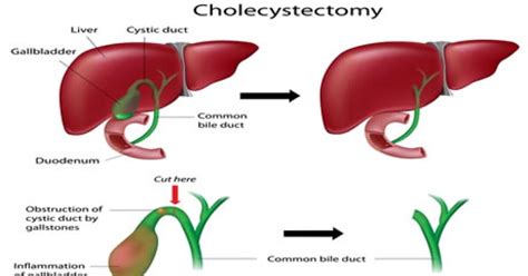 Cholecystectomy Gallbladder Removal Conditions Treated Procedure Types And Recovery