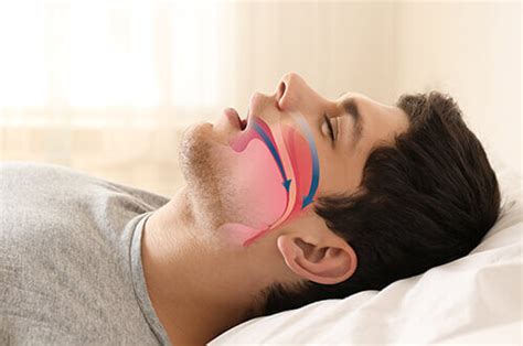 how to know if you have sleep apnea nyc sleepwell