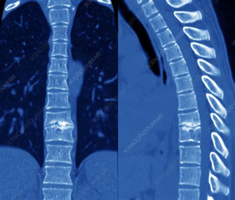 Infected Spine Ct Scans Stock Image M2600371 Science Photo Library
