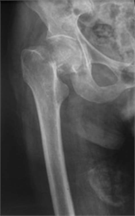 Contrairement à d'autres lésions osseuses, le traitement orthopédique n'est quasiment jamais envisagé pour la fracture du col du fémur. > Fracture du col du fémur - zammel orthopedie