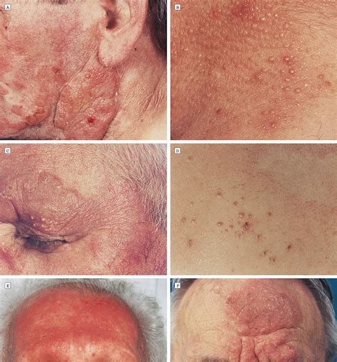 Follicular Mycosis Fungoides A Distinct Disease Entity With Or Without