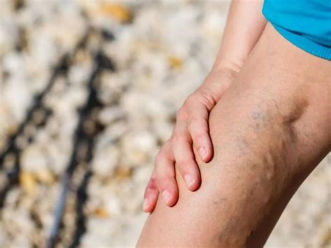 What Happens To Varicose Veins After Treatment Midwest Institute For