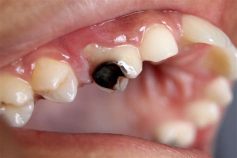 Canker Sores Or Apthous Ulcers Dental Aisle