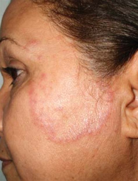 Persistent Facial Erythema Red Face Dermatology Games