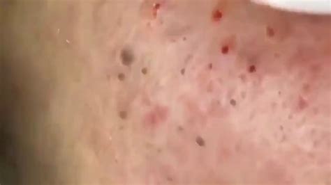 Pimple Popping Removing Blackheads On The Face Acne 159 Youtube