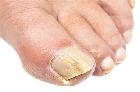 Fungal Nail Infection Treatment Options How To Get Rid Of It Fast