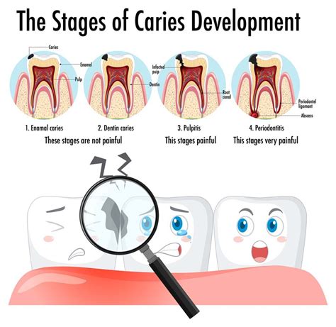 Stages Of Caries Development Infographic West Hollywood Holistic