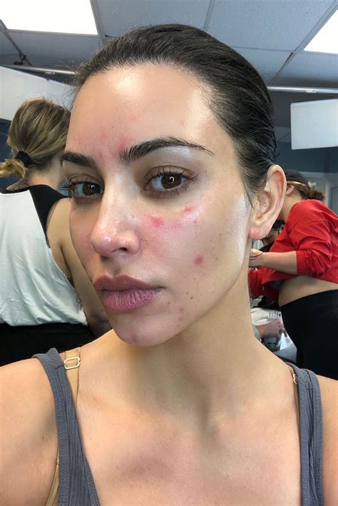 all the times kim kardashian revealed her real skin as fans slam her for erasing psoriasis