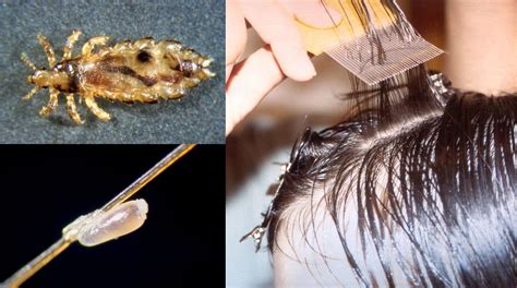 How To Get Rid Of Head Lice Infestation In Your Child
