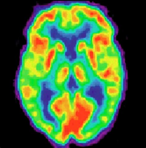 Pet Scan Of A Normal Brain Photograph By Science Stock Photography