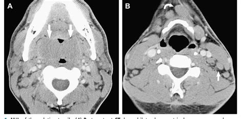 Figure 2 From Imaging Hodgkin And Non Hodgkin Lymphoma In The Head And