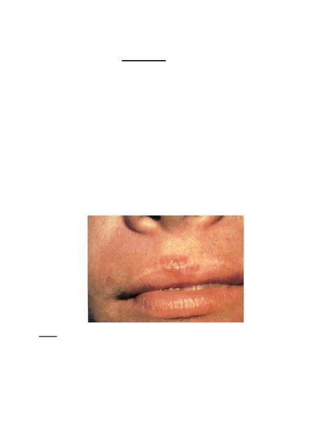 Recurrent Herpes Simplex Secondary Herpetic Lesions Oral And Maxillofacial Pathology