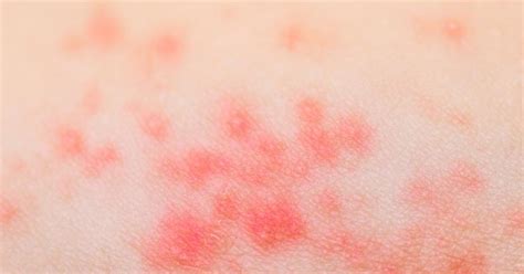Read about heat rash, also called prickly heat or miliaria rubra, which is an itchy rash of small, raised spots and a stinging or prickling sensation on the the symptoms of heat rash are often the same in adults and children. 5 Things You Need to Know About Heat Rash | LIVESTRONG.COM