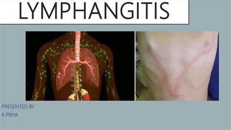 Lymphangitis