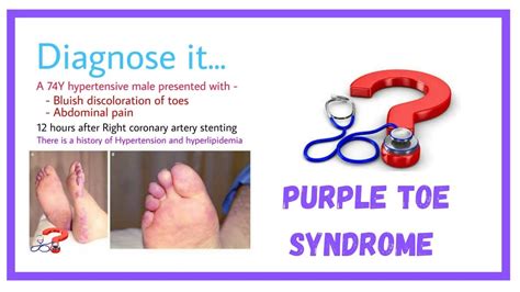 Purple Toes Purple Toe Syndrome It Is Youtube