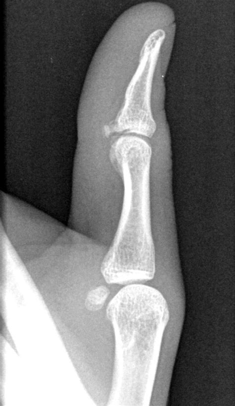 X Ray Thumb 1 View A Photo On Flickriver