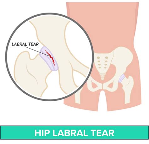 1 Non Surgical Treatment For Hip Labral Tear Matterhorn Fit