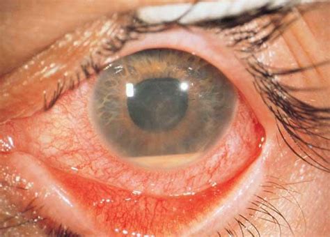 Uveitis Carysmadyson