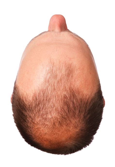 Male Pattern Baldness And Hair Loss Treatments Live Science