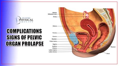 Uterine Prolapse Uterus Vagina Pelvic Floor Muscles Bladder Patient
