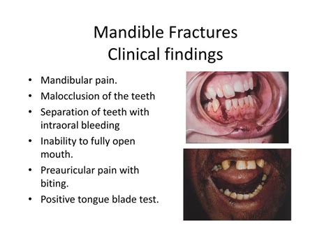 PPT FRACTURES OF MAXILLA AND MANDIBLE PowerPoint Presentation Free