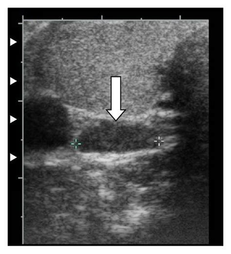 Ultrasound Image Demonstrates A Hypoechoic Mass 19 × 04 × 1 Cm