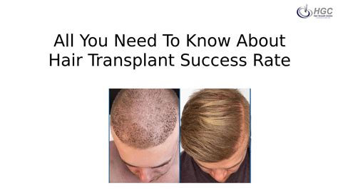 All You Need To Know About Hair Transplant Success Rate By Hairgrowth