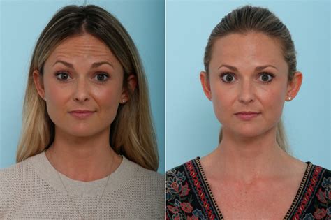 Botox Cosmetic And Xeomin Photos Houston Tx Patient 9401