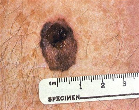 What Does Early Detection Mean For Melanoma Scary Symptoms