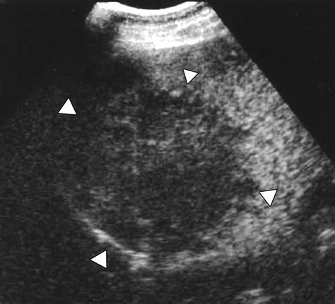 Low Mechanical Index Contrast Enhanced Sonographic Findings Of Pyogenic
