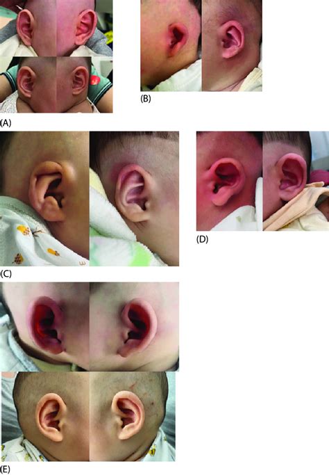 Comparison Of Different Types Of Auricle Deformities Before And After