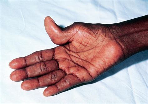 Rheumatoid Arthritis In Hands Of Jamaican Patient Photograph By Sue