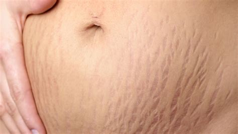 Tattoo Artist Hides Stretch Marks With Skin Colored Ink Before And After Photos Glamour