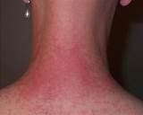 What To Do For Heat Rash