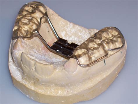 Orthodontic Rapid Palatal Expanders Fox Valley Ortho Lab