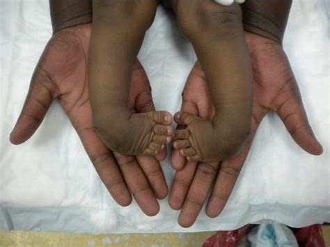 Submitted 7 months ago by brownandyeh. Paediatric Orthopaedic Surgeon | Clubfoot Treatment | Dr ...