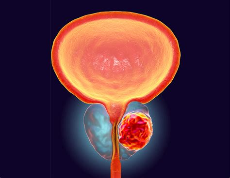 Aggressive Prostate Cancer Metastasis Mechanisms Uncovered