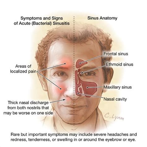 Acute Sinusitis Otolaryngology Jama Jama Network