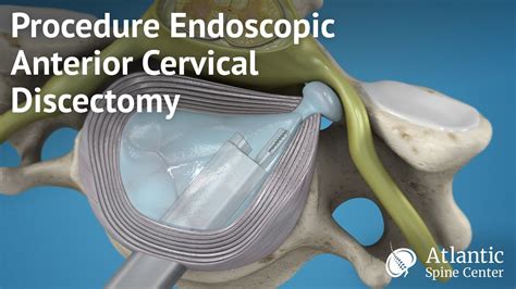 Procedure Endoscopic Anterior Cervical Discectomy Youtube Cervical My Xxx Hot Girl