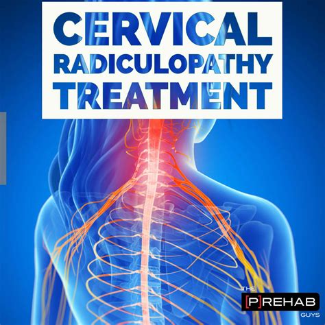 Cervical Radiculopathy In Radiculopathy Cervical Radiculopathy My Xxx
