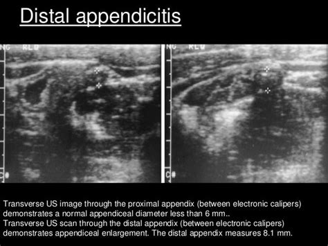 Imaging In Appendicitis