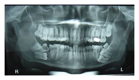 Orthopantomograph Showing Multiple Supernumerary Impacted Teeth