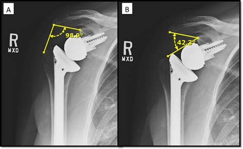 Assessing The Validity Of The Distalization And Lateralization Shoulder
