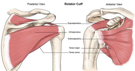 Rotator Cuff Calcific Tendinopathy Hot Sex Picture