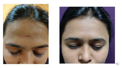 Scar Revision Best Scar Removal Treatment At Venkat Center